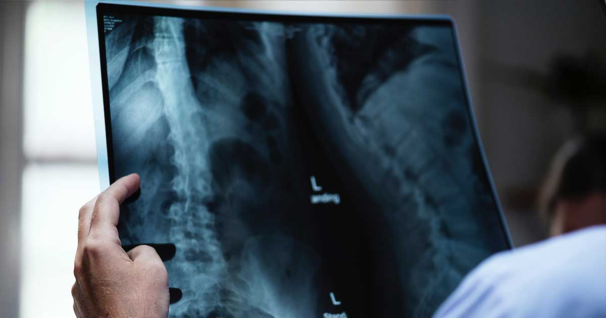 Incapacidad Permanente Revisable: Calificación, Revisión y Recurso Incapacidad Permanente Revisable: Calificación, Revisión y Recurso